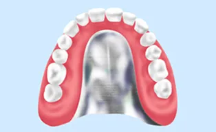 金属床義歯