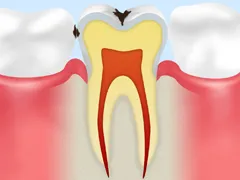 初期のむし歯