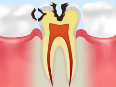 中期のむし歯