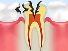 重度のむし歯