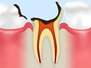 末期のむし歯